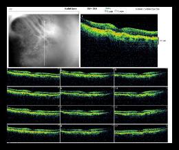 RADIAL LINE OD